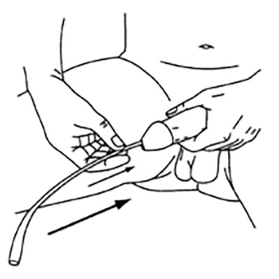 self-intermittent-catheterization self-intermittent-catheterization